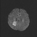 Balo concentric sclerosis (Radiopaedia 50458-55940 Axial DWI 54).jpg