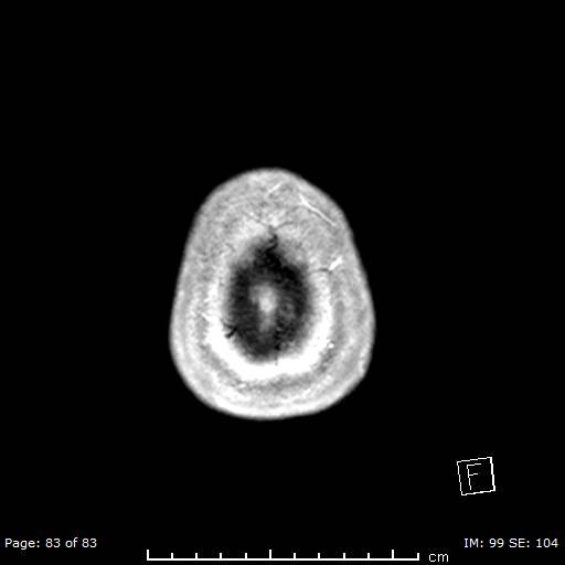 Balo concentric sclerosis (Radiopaedia 61637-69636 Axial T1 C+ 83).jpg