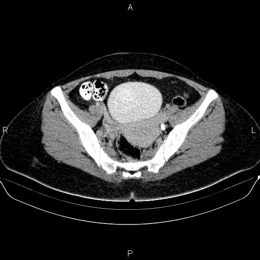Bartholin gland cyst (Radiopaedia 62635-70930 C 37).jpg