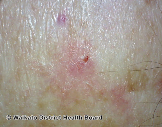 File:Basal cell carcinoma affecting the arms and legs 8 macro (DermNet NZ bcc-8-macro).jpg
