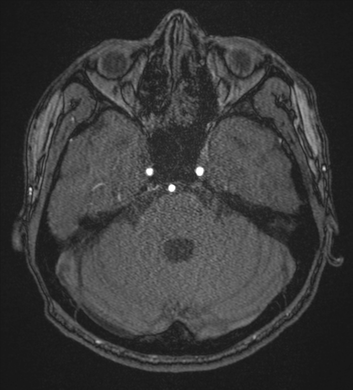 Basal ganglia subacute infarct (Radiopaedia 80201-93521 Axial MRA 24).png
