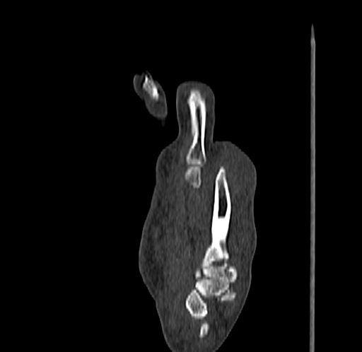 Base of 2nd metacarpal fracture (Radiopaedia 73741-84544 Sagittal bone window 51).jpg
