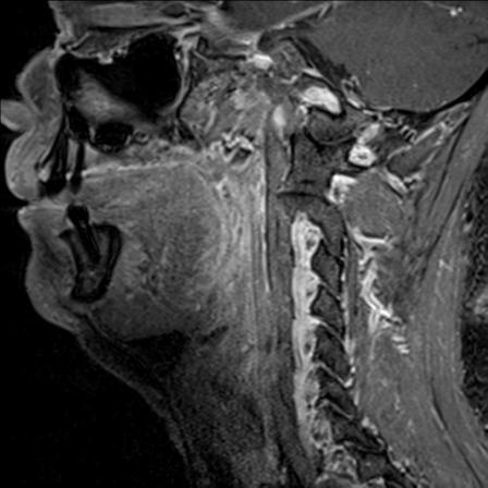 Base of tongue squamous cell carcinoma (Radiopaedia 31174-31884 F 111).jpg