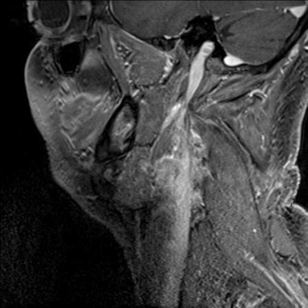 Base of tongue squamous cell carcinoma (Radiopaedia 31174-31884 F 136).jpg