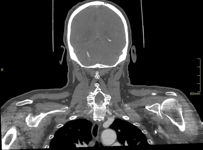 Basilar artery aneurysm (Radiopaedia 56261-62932 B 51).jpg