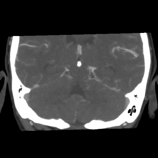 Basilar artery fenestration and aneurysms with subarachnoid hemorrhage (Radiopaedia 40066-42573 B 36).png