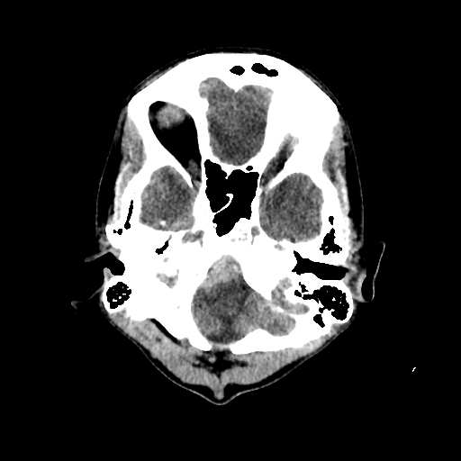 File:Basilar artery perforator aneurysm (Radiopaedia 82455-96597 Axial non-contrast 4).jpg