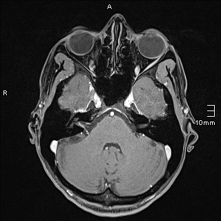 File:Basilar artery perforator aneurysm (Radiopaedia 82455-99523 G 31).jpg