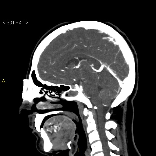 Basilar artery thrombosis (Radiopaedia 16260-15944 C 35).jpg