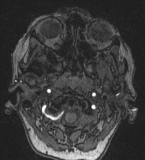 Basilar tip aneurysm (Radiopaedia 26504-26632 MRA 11).jpg