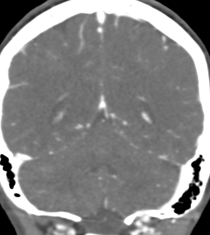 Basilar tip aneurysm with coiling (Radiopaedia 53912-60086 B 113).jpg