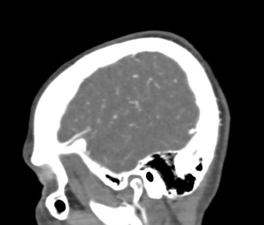 Basilar tip aneurysm with coiling (Radiopaedia 53912-60086 C 16).jpg