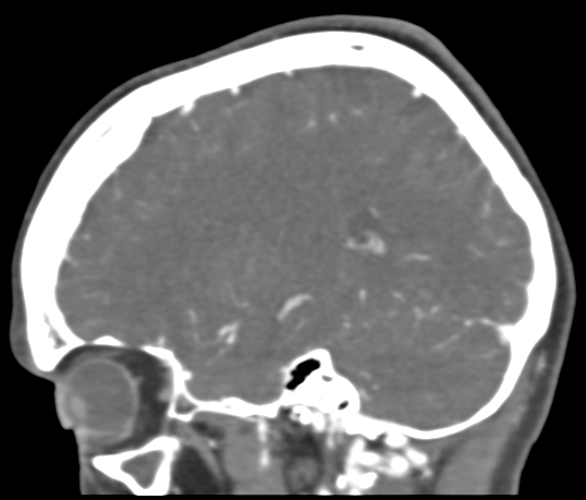 Basilar tip aneurysm with coiling (Radiopaedia 53912-60086 C 93).jpg