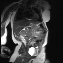 File:Beckwith-Wiedeman syndrome with bilateral Wilms tumors (Radiopaedia 60850-69233 B 15).jpg