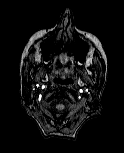 Berry aneurysm of the terminal internal carotid artery (Radiopaedia 88286-104918 Axial TOF 15).jpg