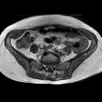 File:Bicornuate uterus (Radiopaedia 61974-70046 Axial T1 15).jpg