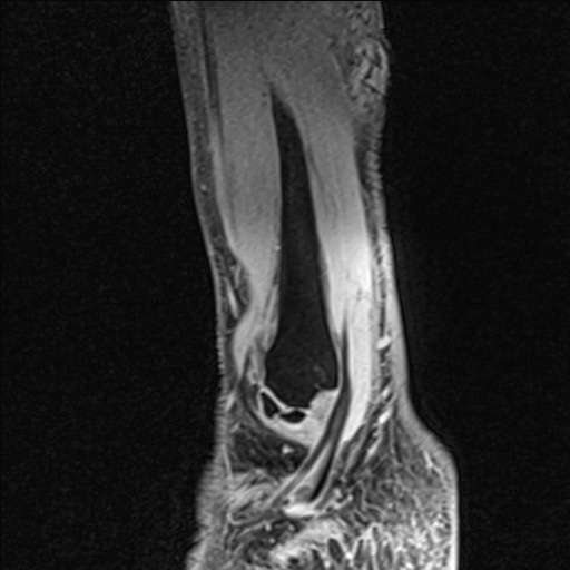 Bilateral Achilles tendon complete tear (Radiopaedia 81344-95051 Sagittal WE - Right 23).jpg