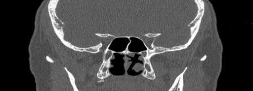 File:Bilateral Ectopic Infraorbital Nerves (Radiopaedia 49006-54084 Coronal bone window 65).jpg
