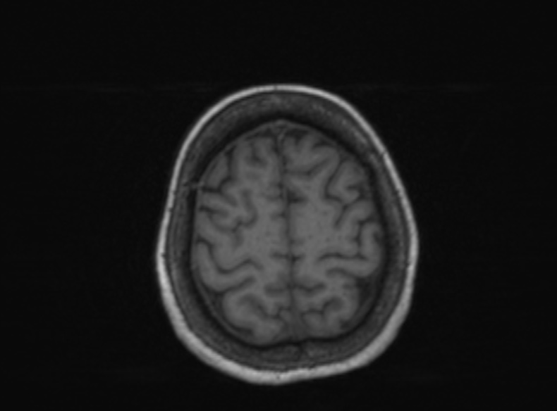 Bilateral PCA territory infarction - different ages (Radiopaedia 46200-51784 Axial T1 150).jpg