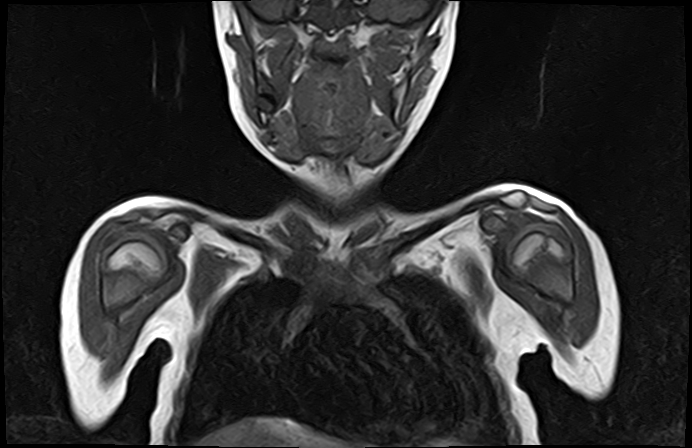 File:Bilateral Sprengel deformity with Klippel-Feil syndrome (Radiopaedia 66395-75650 Coronal T1 6).jpg