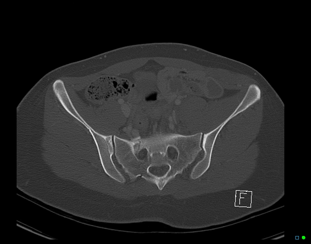 File:Bilateral acetabular fractures (Radiopaedia 79272-92308 Axial bone window 21).jpg