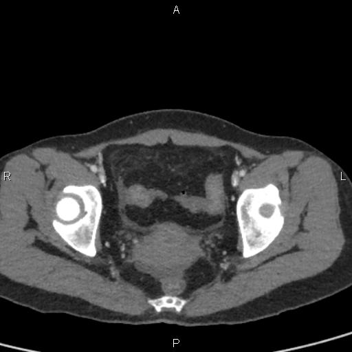 Bilateral adrenal gland hyperenhancement in pancreatitis (Radiopaedia 86642-102753 E 101).jpg