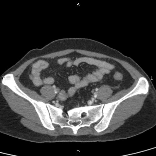File:Bilateral adrenal gland hyperenhancement in pancreatitis (Radiopaedia 86642-102753 E 87).jpg
