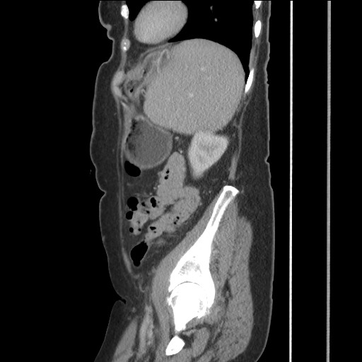 Bilateral adrenal granulocytic sarcomas (chloromas) (Radiopaedia 78375-91007 C 106).jpg