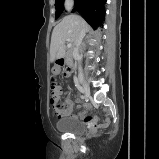 Bilateral adrenal granulocytic sarcomas (chloromas) (Radiopaedia 78375-91007 C 62).jpg
