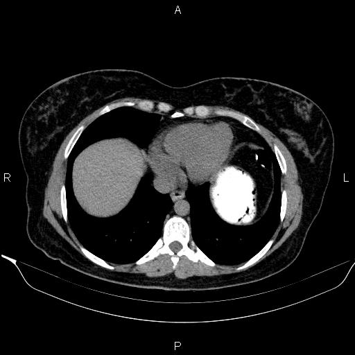 Bilateral adrenal myelolipoma (Radiopaedia 63058-71535 Axial non-contrast 8).jpg