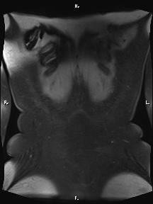 Bilateral adrenal myelolipoma (Radiopaedia 63058-71537 Coronal T1 fat sat 5).jpg