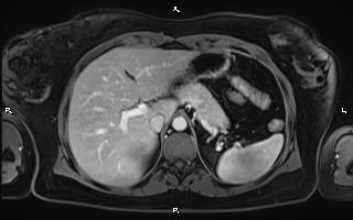 Bilateral adrenal myelolipoma (Radiopaedia 63058-71537 G 28).jpg