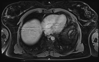 File:Bilateral adrenal myelolipoma (Radiopaedia 63058-71537 H 10).jpg