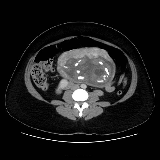 Bilateral adrenal thrombosis (Radiopaedia 58182-65256 A 41).jpg