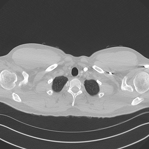 Bilateral atelectasis (Radiopaedia 48666-53675 Axial lung window 3).jpg