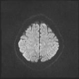 File:Bilateral basal ganglia and thalamic T1 hyperintensities (Radiopaedia 19764-19802 Axial DWI 35).jpg
