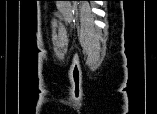 Bilateral benign adrenal adenomas (Radiopaedia 86912-103124 D 66).jpg