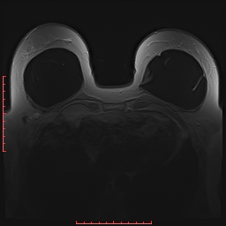 File:Bilateral breast implant rupture (Radiopaedia 24761-25027 PASTA 17).jpg
