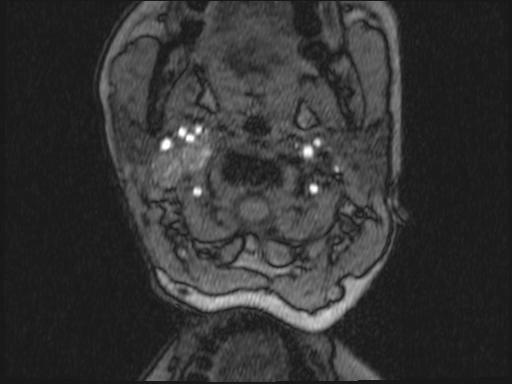 Bilateral carotid body tumors and right glomus jugulare tumor (Radiopaedia 20024-20060 Axial MRA 280).jpg