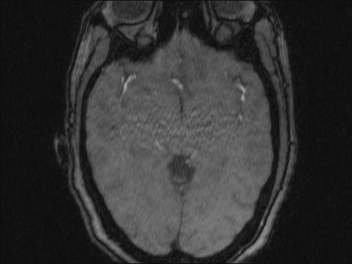 Bilateral carotid body tumors and right glomus jugulare tumor (Radiopaedia 20024-20060 Axial MRA 342).jpg
