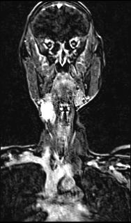 Bilateral carotid body tumors and right glomus jugulare tumor (Radiopaedia 20024-20060 MRA 82).jpg