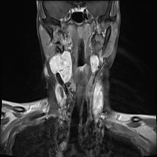 File:Bilateral carotid body tumors and right jugular paraganglioma (Radiopaedia 20024-20060 None 2).jpg