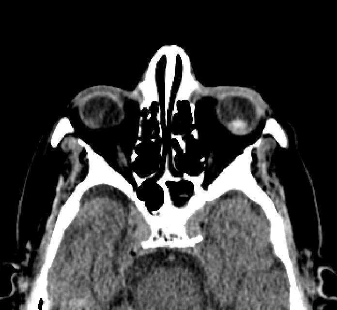 Bilateral ectopia lentis (Radiopaedia 89889-107013 Axial non-contrast 56).jpg