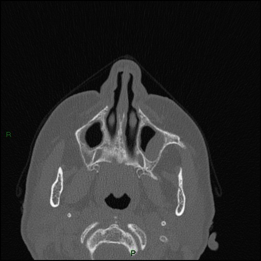 Bilateral frontal mucoceles (Radiopaedia 82352-96454 Axial bone window 222).jpg