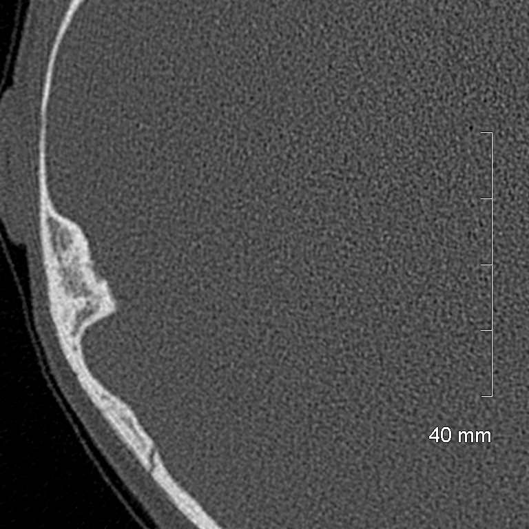 Bilateral grommets (Radiopaedia 47710-52404 Axial bone window 69).jpg