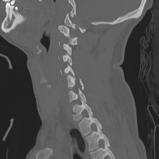 Bilateral locked facets (Radiopaedia 33850-35016 Sagittal bone window 31).png