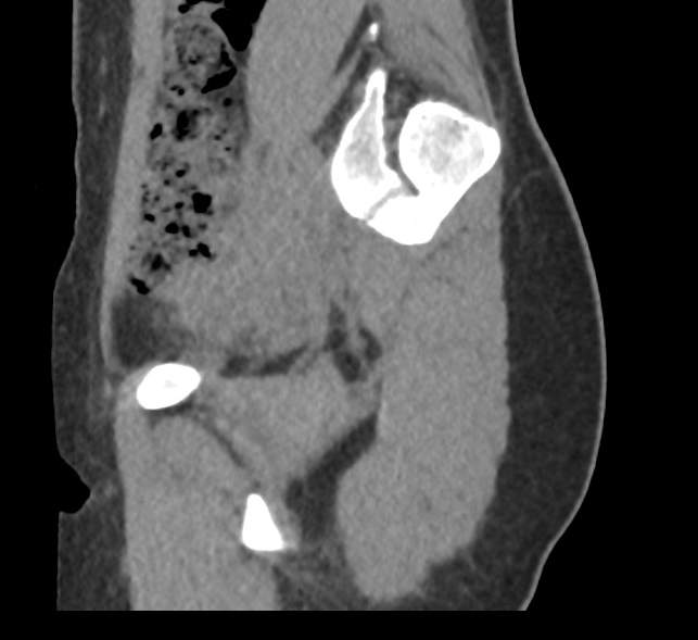 File:Bilateral mature cystic ovarian teratoma (Radiopaedia 88821-105592 D 8).jpg