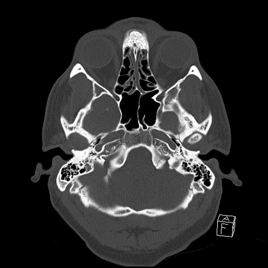 File:Bilateral occipital condyle fracture (type 2) (Radiopaedia 87675-104089 Axial bone window 23).jpg