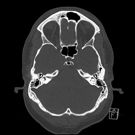 Bilateral occipital condyle fracture (type 2) (Radiopaedia 87675-104089 Axial bone window 34).jpg