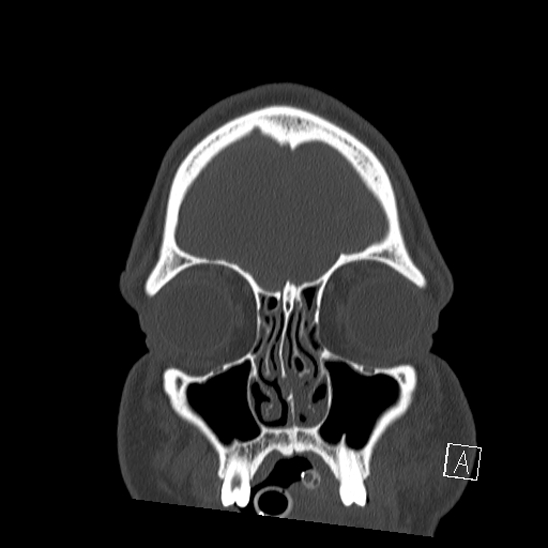 Bilateral occipital condyle fracture (type 2) (Radiopaedia 87675-104089 Coronal bone window 3).jpg